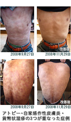 アトピー・自家感作性皮膚炎・貨幣状湿疹の3つが重なった症例