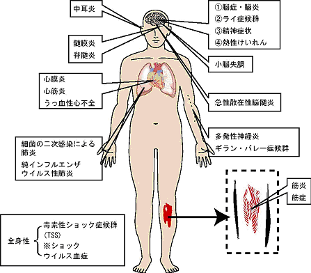 かぜ症候群と漢方・インフルエンザの主な合併症