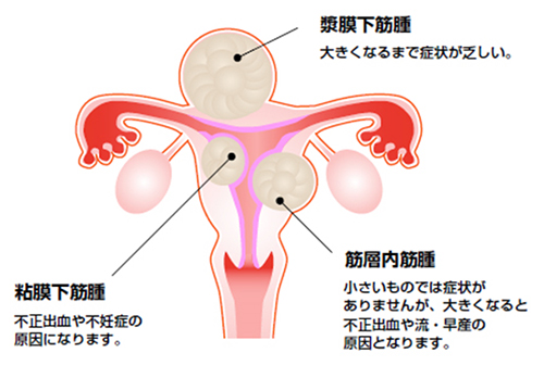 子宮筋腫図説