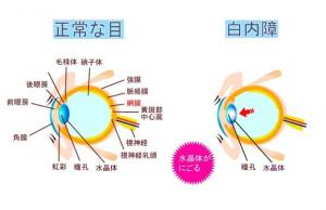 正常な目と白内障
